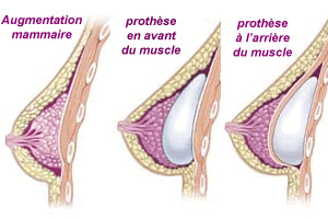 augmentation mammaire clinique