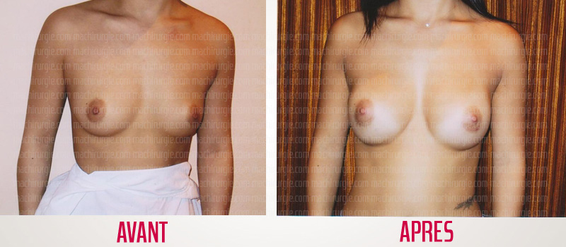 augmentation mammaire avant après cicatrice axillaire